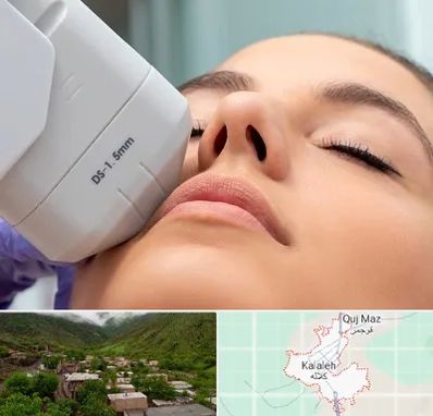 هایفوتراپی در کلاله