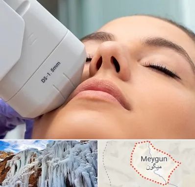 هایفوتراپی در میگون