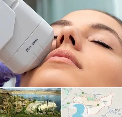 هایفوتراپی در شبستر