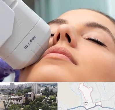 هایفوتراپی در اوین