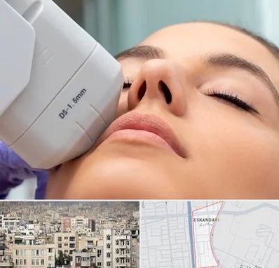 هایفوتراپی در اسکندری