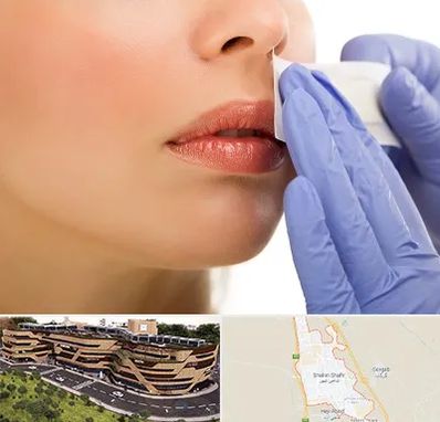 اپیلاسیون صورت در شاهین شهر