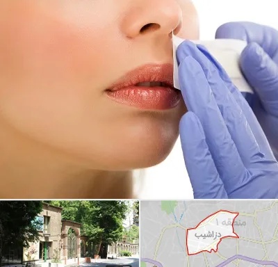 اپیلاسیون صورت در دزاشیب
