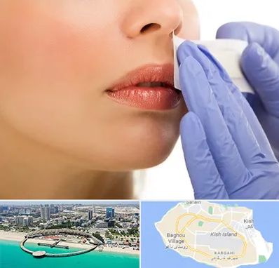 اپیلاسیون صورت در کیش