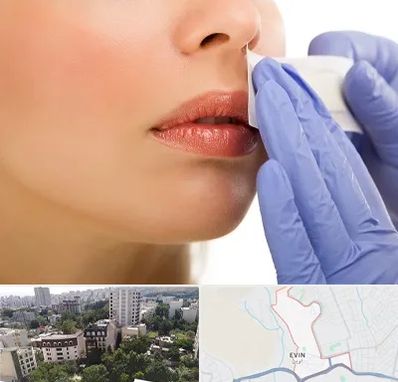 اپیلاسیون صورت در اوین