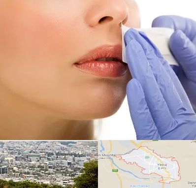 اپیلاسیون صورت در یاسوج