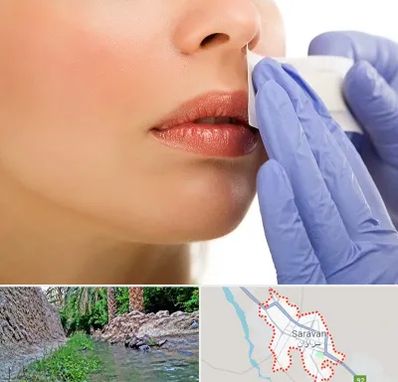 اپیلاسیون صورت در سراوان