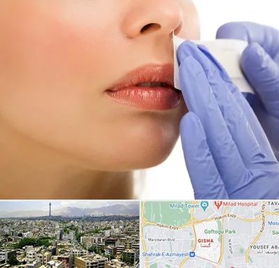 اپیلاسیون صورت در گیشا 