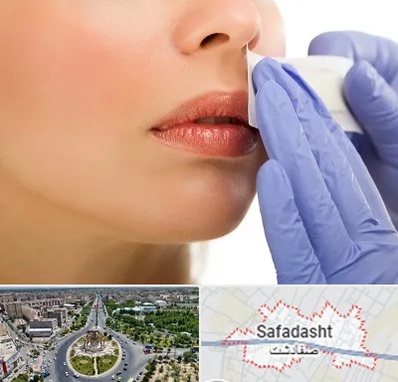 اپیلاسیون صورت در صفادشت