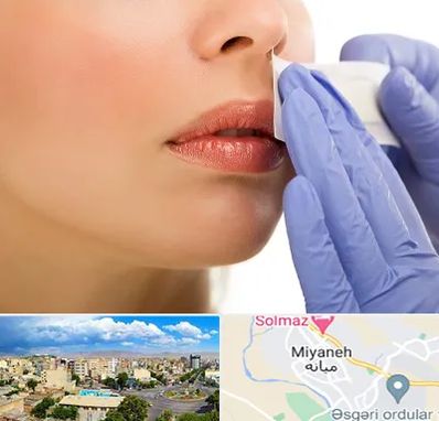 اپیلاسیون صورت در میانه