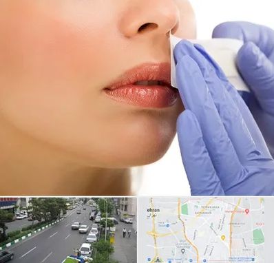 اپیلاسیون صورت در ستارخان 