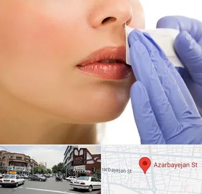 اپیلاسیون صورت در خیابان آذربایجان