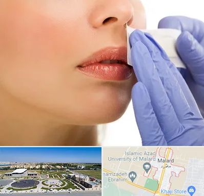 اپیلاسیون صورت در ملارد