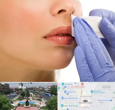 اپیلاسیون صورت در بهارستان 