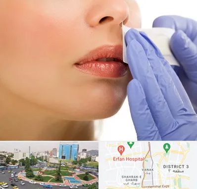 اپیلاسیون صورت در ونک 