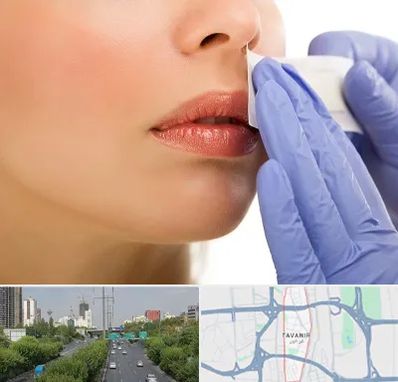 اپیلاسیون صورت در توانیر