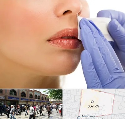 اپیلاسیون صورت در بازار تهران