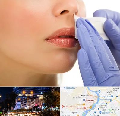 اپیلاسیون صورت در کیانپارس اهواز