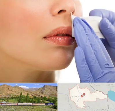اپیلاسیون صورت در خاش