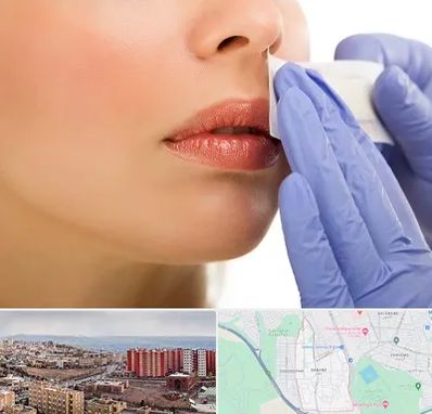 اپیلاسیون صورت در سهند تبریز