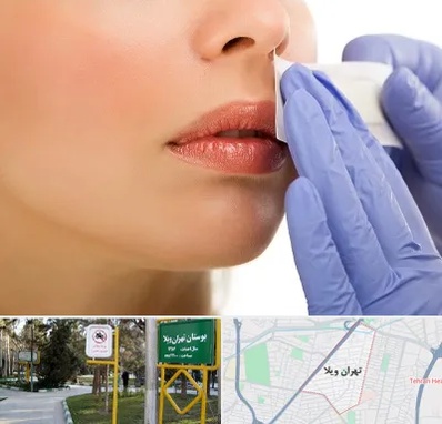 اپیلاسیون صورت در تهران ویلا