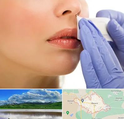 اپیلاسیون صورت در مرند