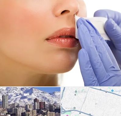 اپیلاسیون صورت در ازگل