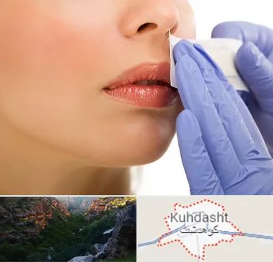 اپیلاسیون صورت در کوهدشت