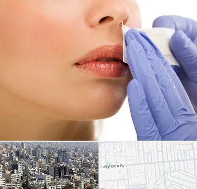 اپیلاسیون صورت در جیحون