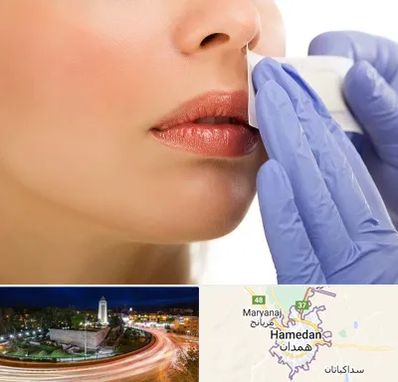 اپیلاسیون صورت در همدان