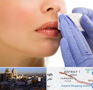 اپیلاسیون صورت در فرمانیه 