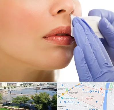 اپیلاسیون صورت در گلستان اهواز