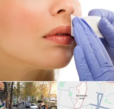 اپیلاسیون صورت در کاشانک