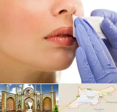 اپیلاسیون صورت در سمنان