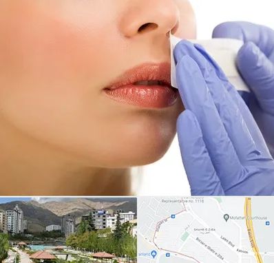 اپیلاسیون صورت در شهر زیبا 