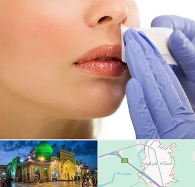 اپیلاسیون صورت در آستانه اشرفیه