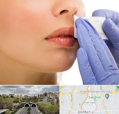 اپیلاسیون صورت در یوسف آباد 