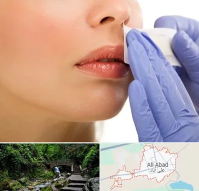 اپیلاسیون صورت در علی آباد کتول