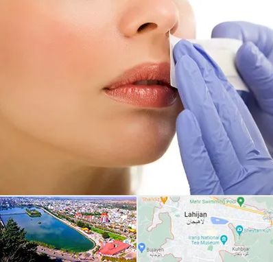 اپیلاسیون صورت در لاهیجان