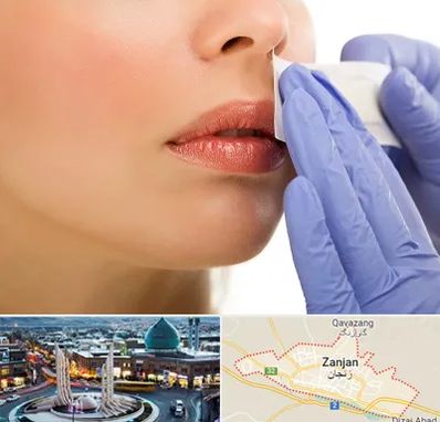 اپیلاسیون صورت در زنجان