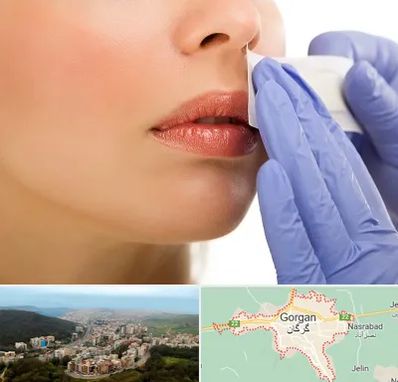 اپیلاسیون صورت در گرگان