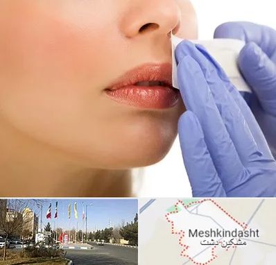 اپیلاسیون صورت در مشکین دشت