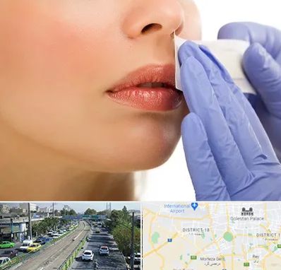 اپیلاسیون صورت در جنوب تهران 