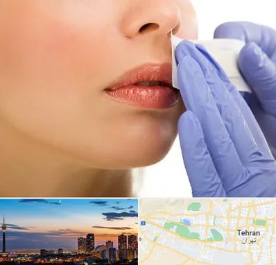 اپیلاسیون صورت در غرب تهران 