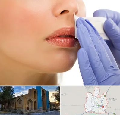 اپیلاسیون صورت در اهر