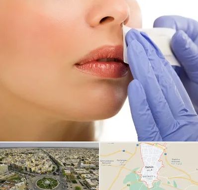 اپیلاسیون صورت در قزوین