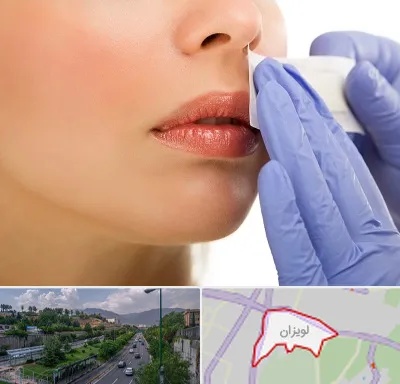 اپیلاسیون صورت در لویزان