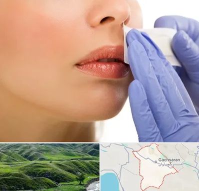 اپیلاسیون صورت در گچساران