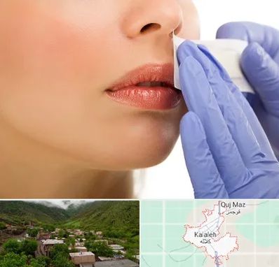 اپیلاسیون صورت در کلاله