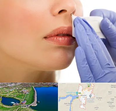 اپیلاسیون صورت در مهاباد